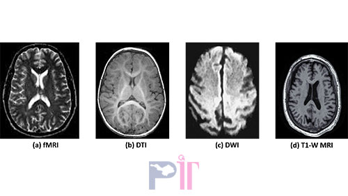 تشخیص آلزایمر از MRI مغز با هوش مصنوعی
